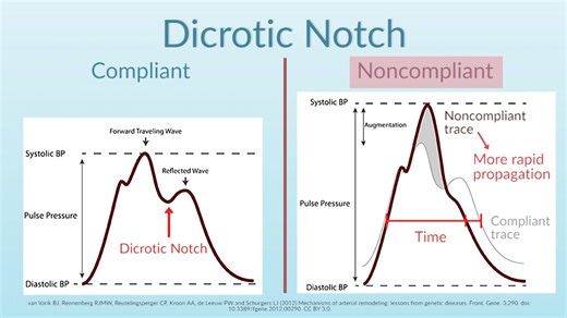 《动脉压力波形解读》Interpreting Arterial Pressure Waveforms by （J. DiNardo）