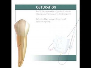 Continuous Wave Of Condensation Elements Obturation System