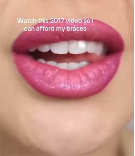 All You Need to Know About Braces