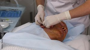 Thread lifting for a male patient is an innovative method of correcting face lifting with special ultra-thin and durable threads with multidirectional notches.