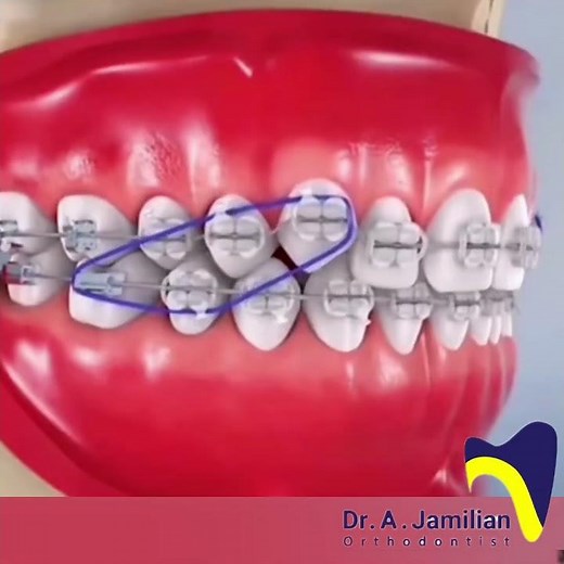 Elastics in Fixed Orthodontics: How Rubber Bands Move Teeth Faster #elastic #rubber #orthodontics