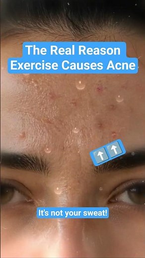 The Real Reason Exercise Causes Acne