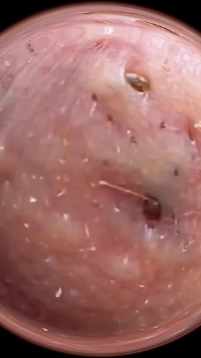 große Akne hinter dem Ohr teil 1 #akne #mitesser #aknederm #aknetedavisi #pickel #fürdich