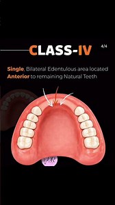 Kennedy Classification in 60 seconds 🦷 #dentistry #dentalstudents