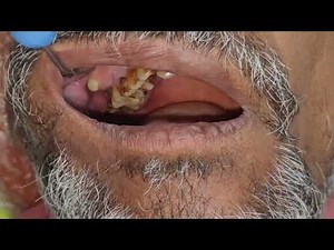 case series: Abscess drainage