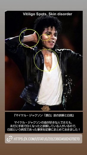 マイケル・ジャクソンの白斑の真実とは