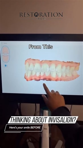 Restoration Smiles | Family Dentistry Office 👨‍👩‍👧‍👦 on Instagram: "New year, new smile! Start Invisalign now to take advantage of your 2025 benefits and be on your way to straighter teeth by spring. DM us to schedule your scan! #InvisalignTomball #ClearAligners #RestorationSmiles"