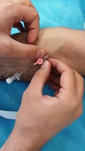 Peripheral IV catheter insertion #medicine #health #Intravenous #medical