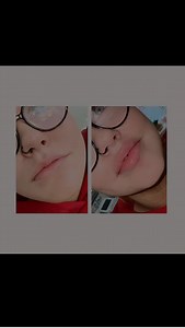 Our client’s first-ever lip filler — and what a transformation!  The goal? Natural shape, gentle volume, and definition that enhances her features — not changes them. Subtle doesn’t mean invisible… it means just right. ✨ Ready for your first lip filler experience? Let’s make it perfect  Envy Aesthetics | DM to book #LipFillerTransformation #FirstTimeFiller #NaturalLips #EnvyAesthetics #ConfidenceBoost | Envy Aesthetics | Facebook