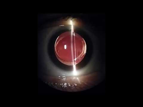 Sineresis vitrea / Vitreous Syneresis/ Eye Floaters