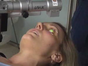 Collagen Cross-Linking for Keratoconus- patient testimonial & video procedure