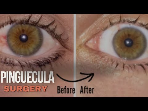 Pinguecula Surgery: Cosmetic Outcomes with Dr. Gulani