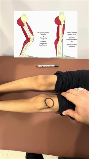 مشكلة صابونة الركبة عند حالات الشلل الدماغي Patella Alta #دكتور_اسماعيل_ابوشادي