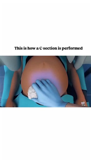 World of Biology on Instagram: "The process of C-section explained . . Amazing Animation by - @dmanimation (Thank you ❤️) . . Link to original video on Youtube channel 👇 https://youtu.be/pSJcxYg1QQ4?si=VugxpkIiHBNHLkYJ"