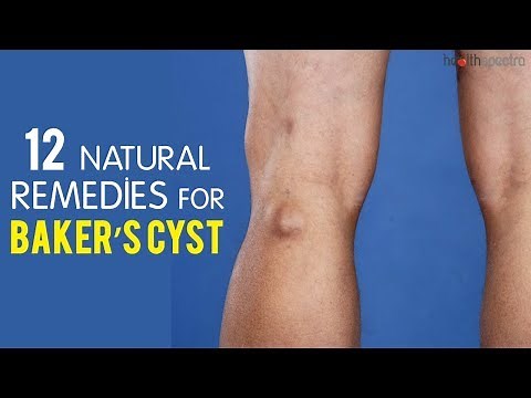 12 Natural Remedies For Baker's Cyst | Healthspectra