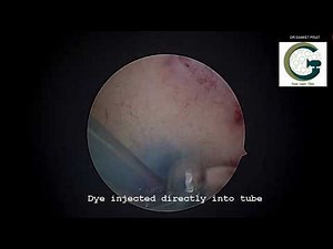 Patient Information: Blocked Tubes surgery