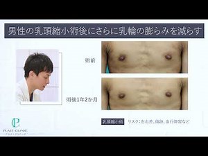 男性の乳頭および乳輪の膨らみを減らす手術 その２