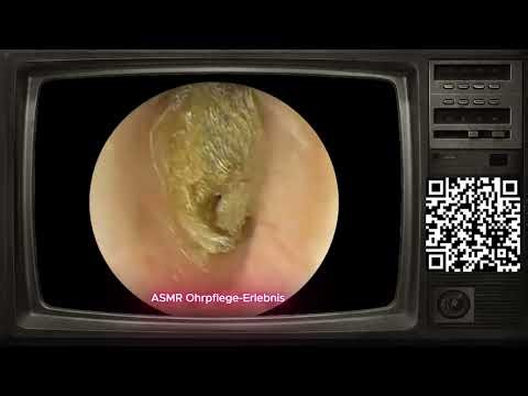😴Deep Ear Wax Removal & Cleaning (Satisfying ASMR)