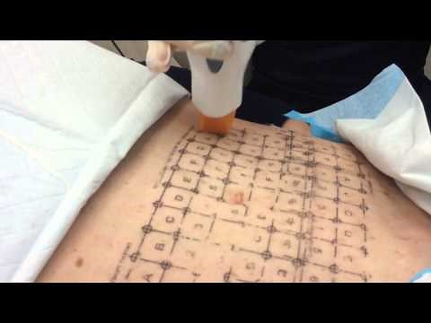 Thermage Treatment of the Abdomen - Dr. Michael Kaminer