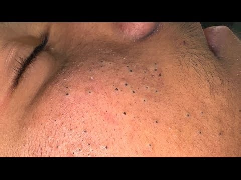The Ultimate Facial Care Routine | Deep Pore Cleansing & Acne Solutions