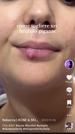 Come Trattare un Brufolo Gigante - Schiaccia Brufoli e Cerotti per Brufoli
