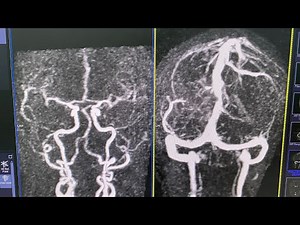 MRI TWIST BRAIN(Time-resolved angiography With Interleaved Stochastic Trajectories)MRA& MRV Contrast
