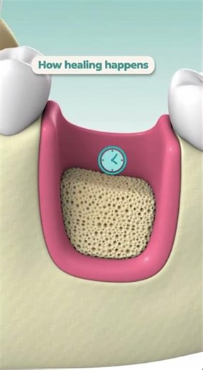 🦷 How Does Healing Work After a Tooth Extraction With a Bone Graft?