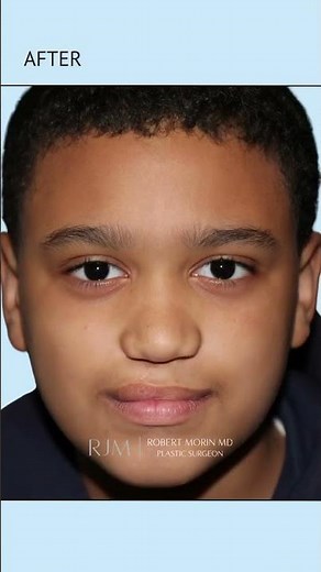Cleft Lip & Palate Repair: 10-Year Results | Dr. Robert Morin