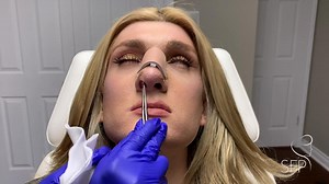Female Transgender patient undergoing Splint Removal following Rhinoplasty