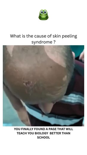 Explaining Biology on Instagram: "Skin peeling on the head, often associated with a dry, flaky scalp, can be caused by various factors including dehydration, overuse of hair products, skin conditions like seborrheic dermatitis or psoriasis, and even sunburn. In some cases, genetic conditions like Peeling Skin Syndrome can also lead to skin peeling. Common Causes: Dry Scalp: When the scalp loses too much moisture, it can become dry and flaky, leading to peeling skin. This can be caused by weather