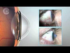 CIRUGÍA QUERATOCONO - CLINICA OFTALMOLOGICA DE CARTAGENA