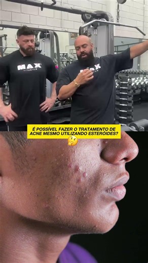 Is it possible to treat acne even while using steroids? #shortsvideo #youtubeshorts #gym