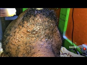 What triggers Razor Bumps & How To Prevent/Treat