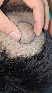 212K views · 609 reactions | Scalp Lump | Dr Khaled's Tumour Helpline | Facebook