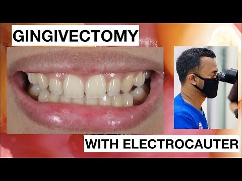 Gingivectomy in simple case Lateral with ElectroCautery | General Dentist Griya RR