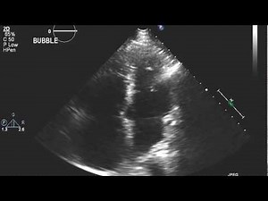 Echocardiogram with Bubble Study: Extracardiac Shunt