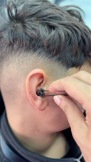 ازالة الحبايه المتسلطنة من الودان✂️🥵 #fyp #foryou #foryoupage #viral #explore #comedy #asmr