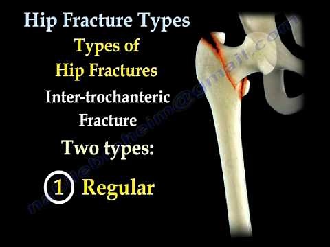 Hip Fractures, Types and fixation - Everything You Need To Know - Dr. Nabil Ebraheim