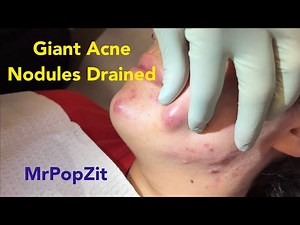 Giant inflammatory hormonal acne nodules drained and injected. Incision and drainage.