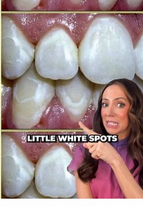 White spots on your teeth? These might be decalcification areas, which are the first sign your enamel is losing minerals. Common causes: plaque, braces, sugary foods, low fluoride, and more! They’re mostly cosmetic at first, but can turn into tooth decay/cavities if left untreated. Prevention & treatment: 🦷Brush 2x/day, 2 minutes (especially around braces & gumline) 🦷Floss/interdental clean daily 🦷Limit sugary/acidic drinks 🦷Rinse with water after eating/drinking 🦷Chew xylitol gum after eat