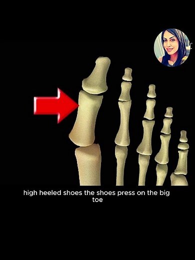 Bunions Explained: Causes, Symptoms, and Treatment Options 👣