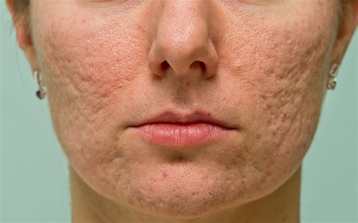 PS教程：快速修复面部斑点疤痕以及光滑皮肤