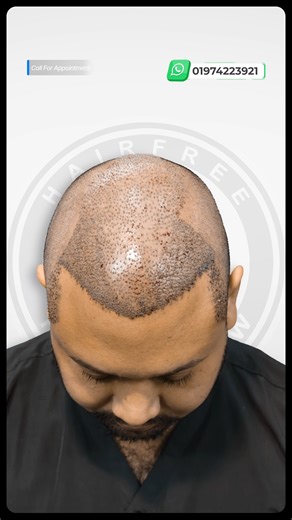 3800 Grafts Hair Transplant | Pain & Misconception Explained | Hairfree & Hairgrow Bangladesh Book your appointment today! WhatsApp: 8801974223921 𝗗𝗵𝗮𝗸𝗮 𝗕𝗿𝗮𝗻𝗰𝗵 Address: Progress Tower, Road-23, House-01, Gulsan-1, Dhaka, Bangladesh. 𝗖𝗵𝗶𝘁𝘁𝗮𝗴𝗼𝗻𝗴 𝗕𝗿𝗮𝗻𝗰𝗵 Address: Amara Building, SFA Tower 4th Floor, Prabartak Circle, Panchalish, Chittagong. #HairTransplantBangladesh #HairTransplantSurgery | HairFree & HairGrow Bangladesh