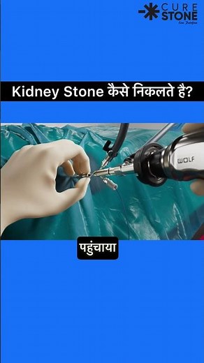 Mini Perc/PCNL Surgery Explained in 3D | Advanced Laser Kidney Stone Removal | Dr Deepanshu Gupta