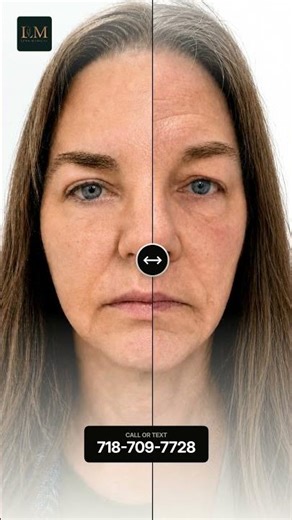filler, botox, upper eyelid after
