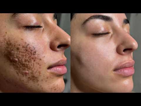 Full Face Blackhead Removal | Deep Pore Detox Facial Results