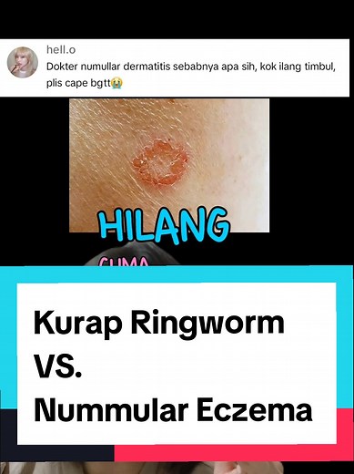 Kurap Ringworm vs. Nummular Eczema: Key Differences