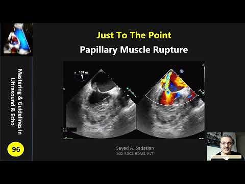 Just to the point: papillary muscle rupture