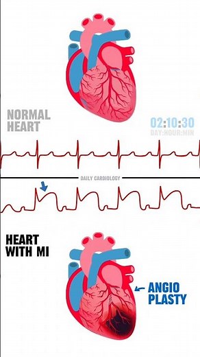 ECG changes during different stages of myocardial infarction #ecg #stemi #cardiology