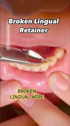 BROKEN LINGUAL WIRE